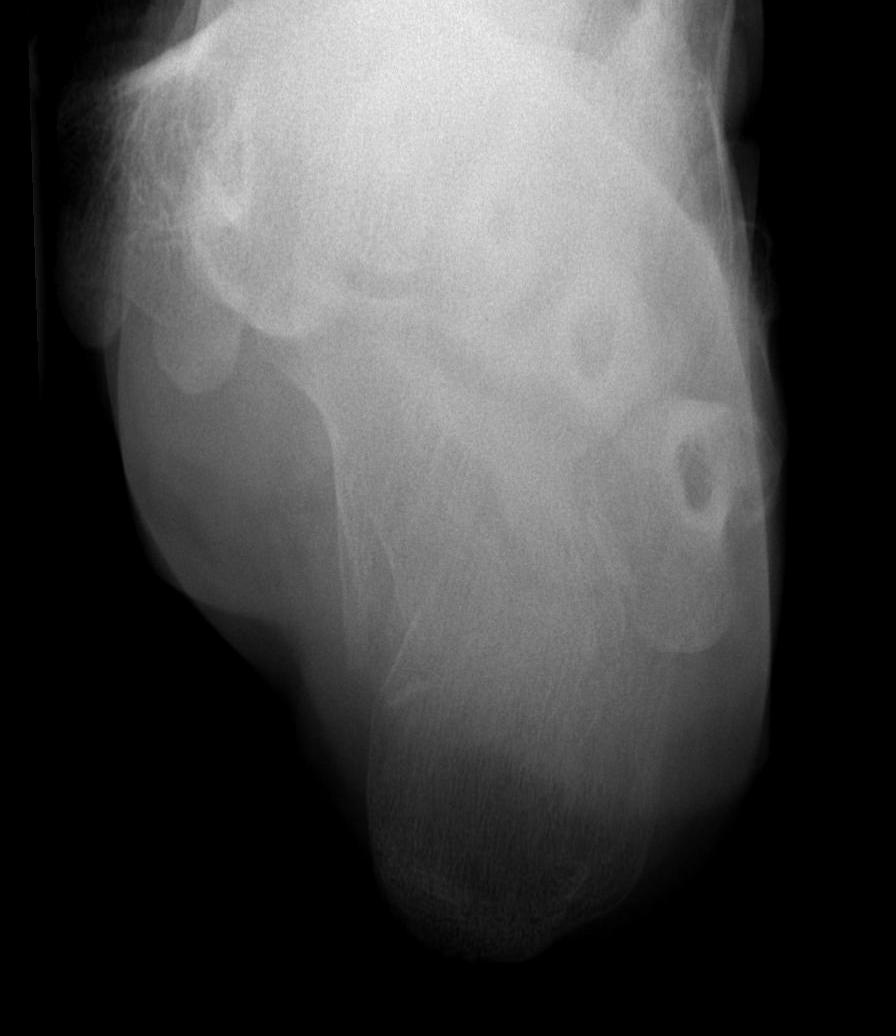 Calcaneal Fracture Harris Axial View